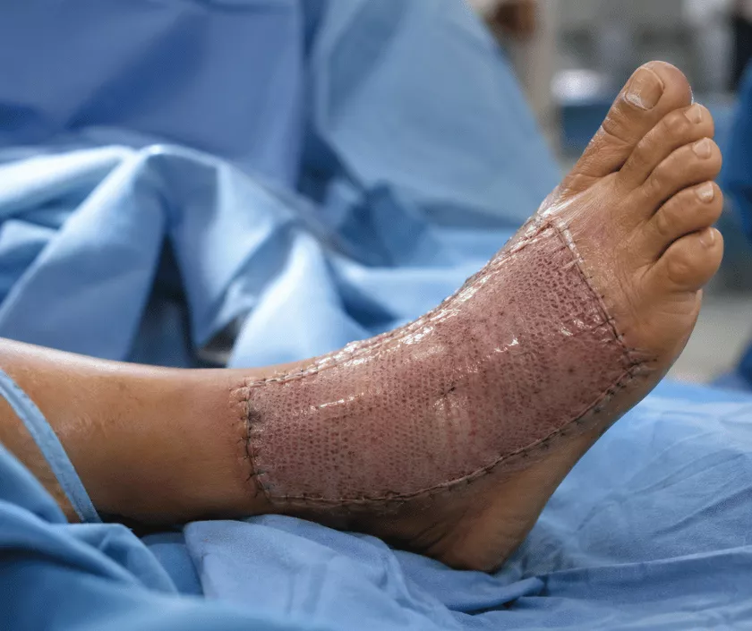 Skin Grafting