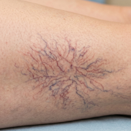 Spider Vein