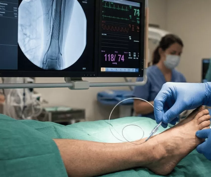 Stenting