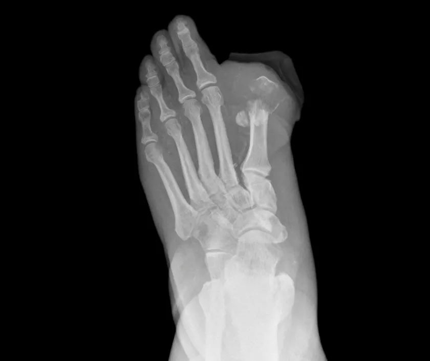 Toe Amputation