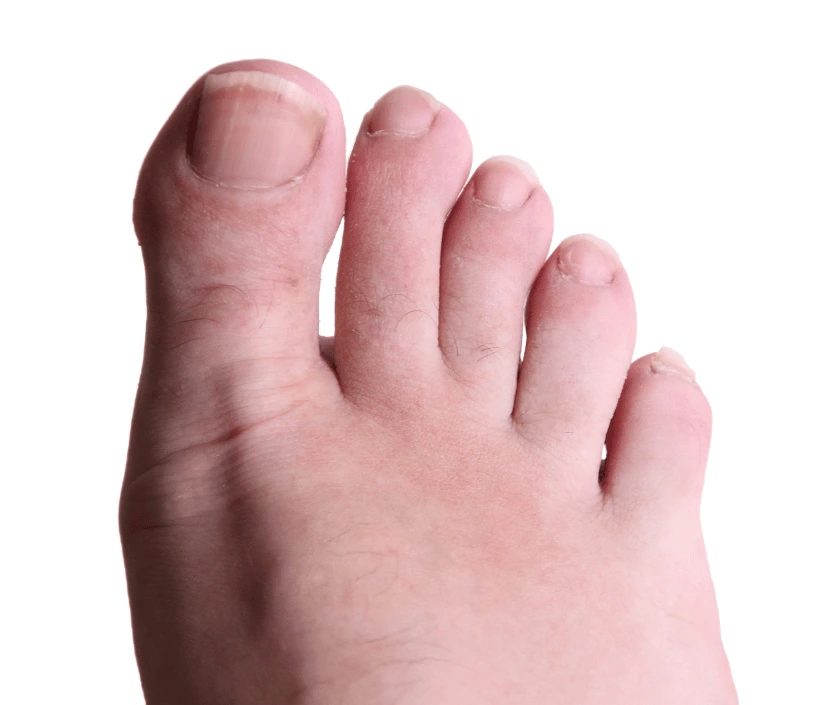 toe-salvage-procedures