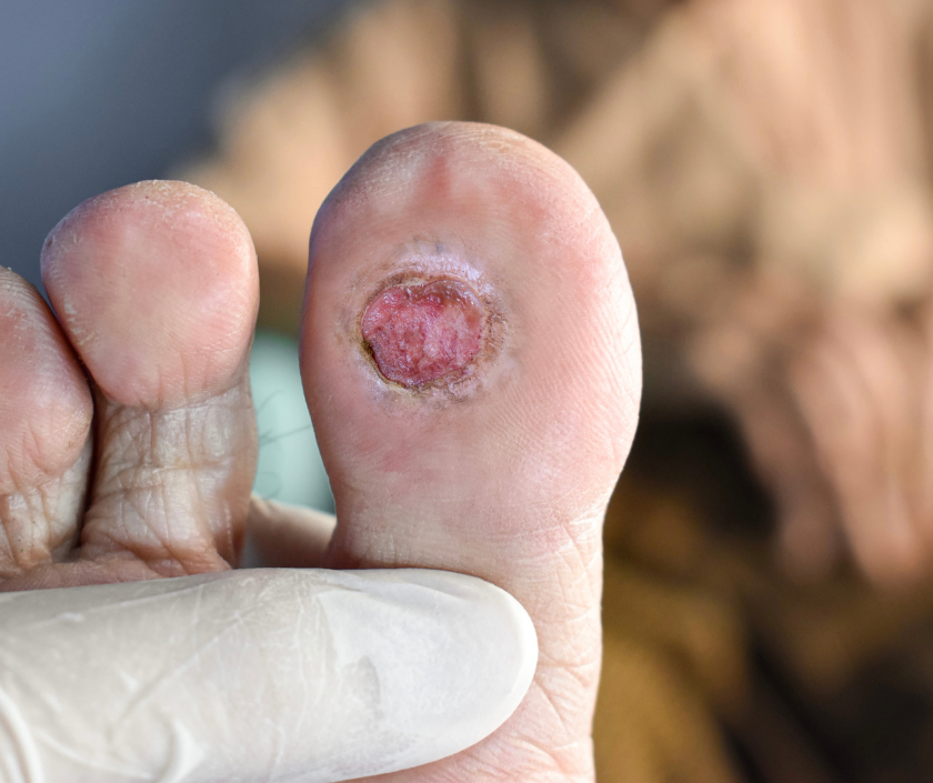 Ulcer Assessment at Elegance Diabetic Foot & Ulcer Clinic (EDFC), India