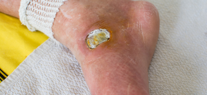 Diabetic Foot Ulcer treatment in India at Elegance Diabetic Foot & Ulcer Clinic (EDFC)