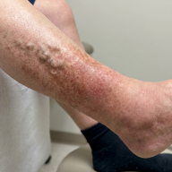 Varicose Eczema