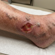 Varicose Vein Ulcer
