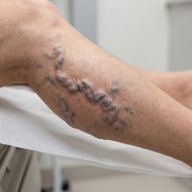 Varicose Vein