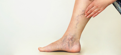 Venous Ulcer treatment in India at Elegance Diabetic Foot & Ulcer Clinic (EDFC)