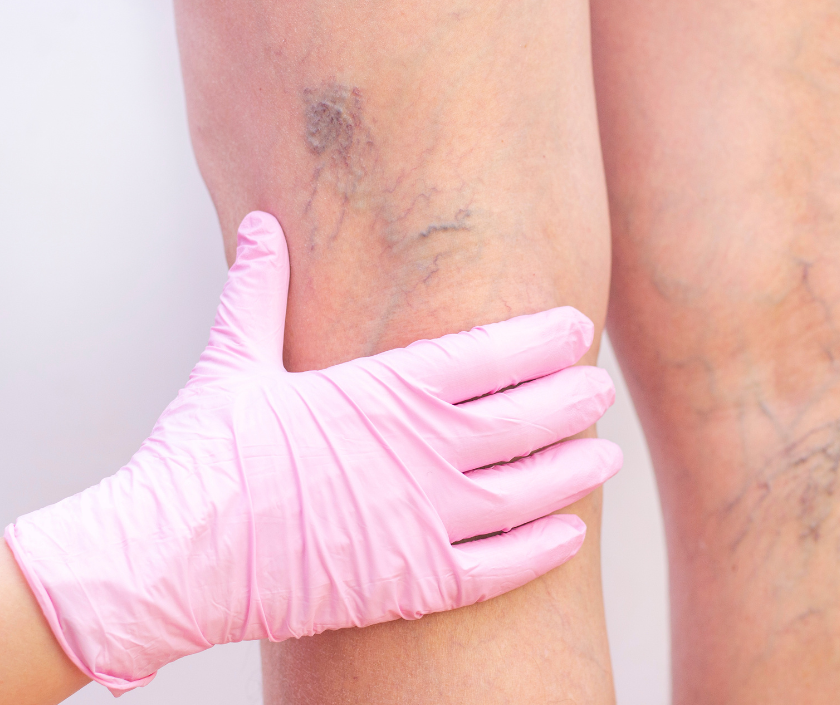 Vascular Assessment at Elegance Diabetic Foot & Ulcer Clinic (EDFC), India