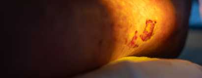 Vasculitic Ulcers at Elegance Diabetic Foot & Ulcer Clinic (EDFC), India