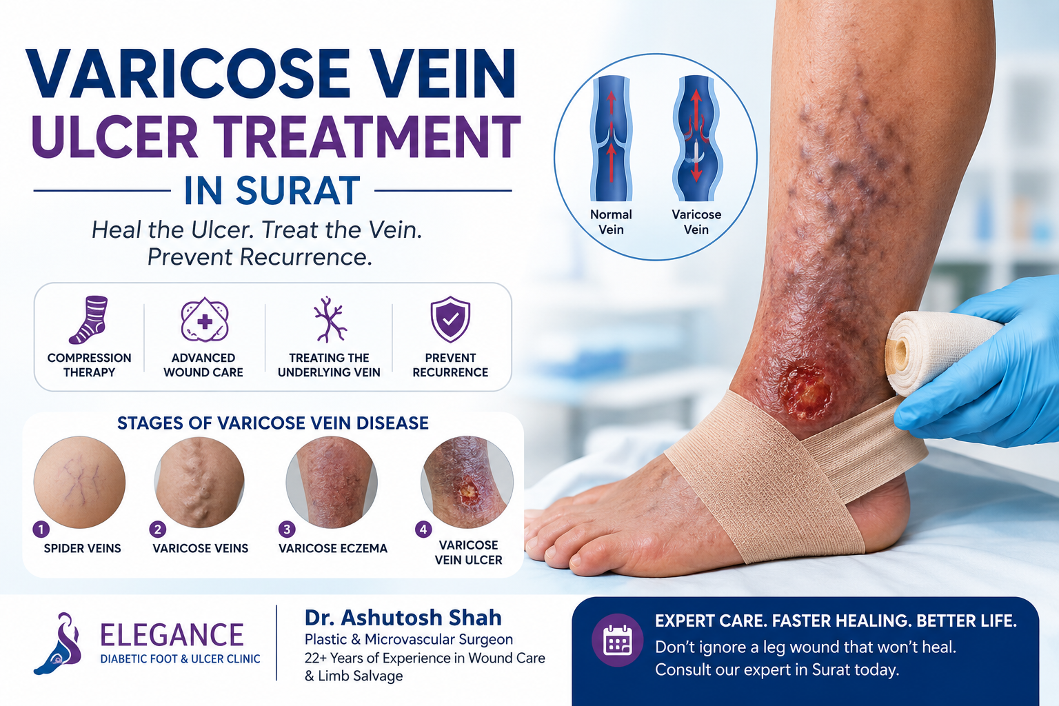 Varicose Vein Ulcer Treatment in Surat: Causes, Stages and Recovery