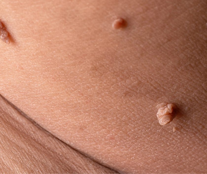 Close-up of small viral warts on the skin