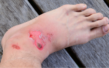 Wound Culture & Sensitivity, Tissue & Blood Culture at Elegance Diabetic Foot & Ulcer Clinic (EDFC), India