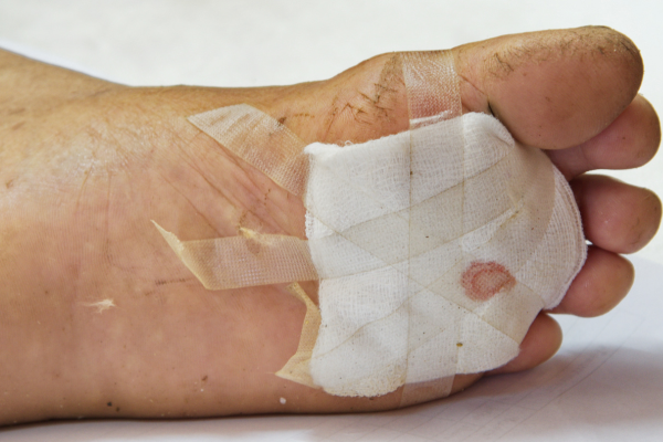 Wound Reconstruction at Elegance Diabetic Foot & Ulcer Clinic (EDFC), India