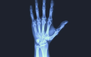 X-rays at Elegance Diabetic Foot & Ulcer Clinic (EDFC), India